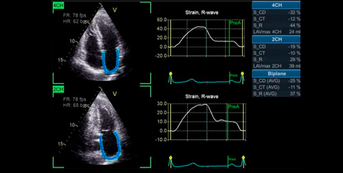 Envelhecimento e análise ecocardigoráfica funcional do átrio esquerda (Arquivo Brasileiro de Cardiologia)