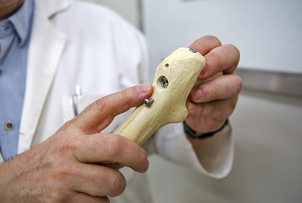 Haste intramedular foi desenhada especificamente para fraturas do colo do fêmur